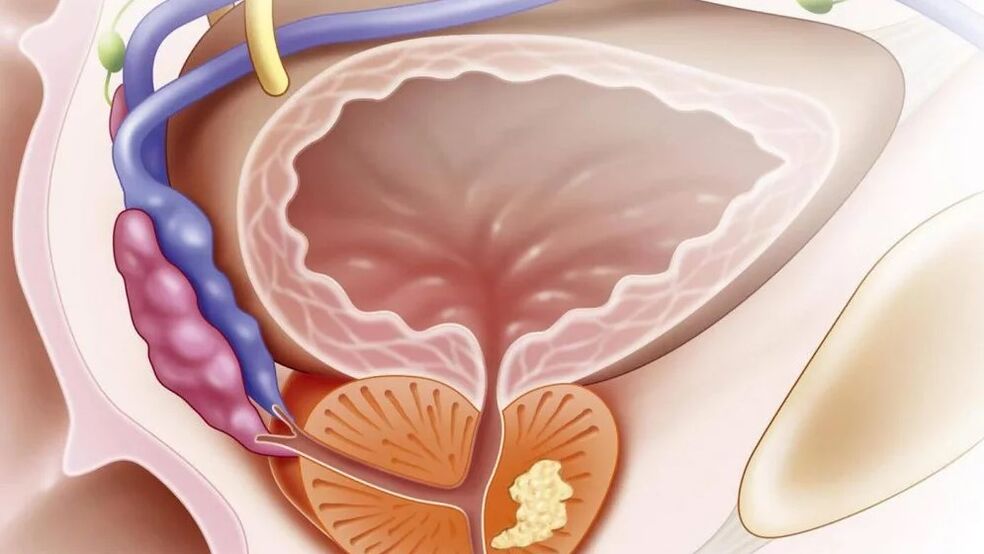 Nebacterial chronic prostatitis